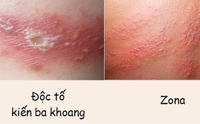 Doc to kien ba khoang va zona than kinh